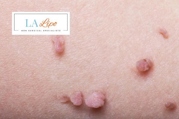 Does cryopen skin tag removal New Cross hurt? Find out now call our team today!