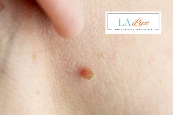 Book skin tag removal New Cross today speak to our team now!