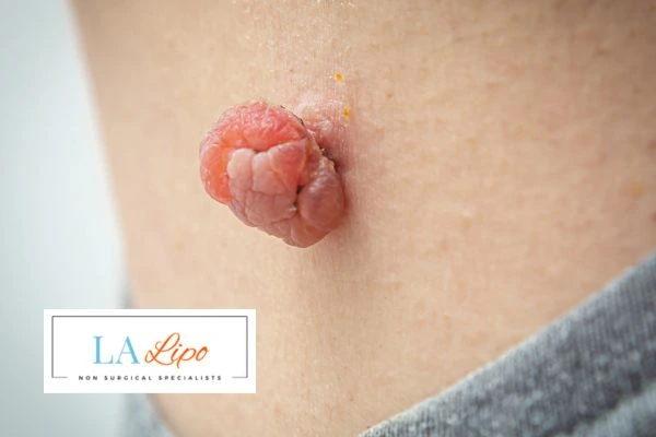 Interested in skin tag removal New Cross? Concerned about the pain? Find out more today!