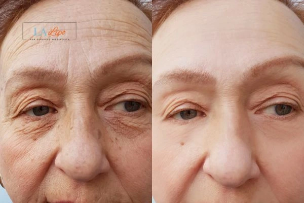 The powerful benefits of Morpheus8 Treatment New Cross - Call Our team today!