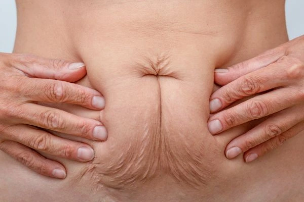 Should I Combine Diastasis Recti Treatment with Body Contouring for Better Results New Cross?