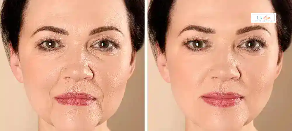 How Long Does It Take to See Results and How Long Do They Last New Cross?